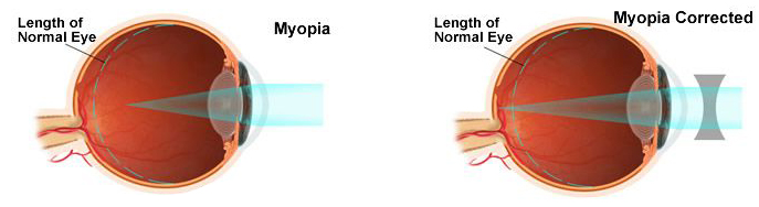 visual of Short-Sightedness (Myopia)